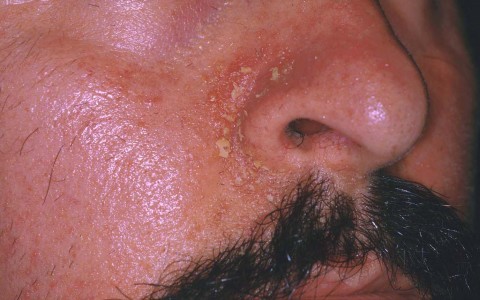 Dermatite seborroica