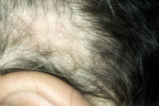Alopecia da frizione in lattante